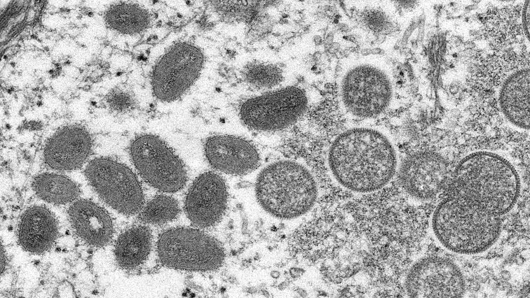 Gauteng Health dismisses claims of myiasis infection outbreak – SABC News
