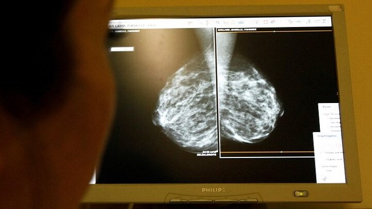 Wits researchers discover unique breast cancer genes in black women – SABC News
