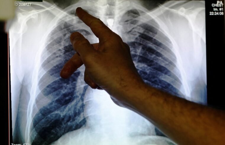 KZN Health institute says govt to prep for roll-out of new TB drug – SABC News